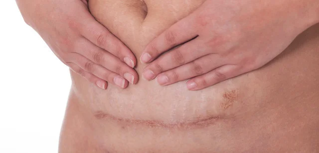 疤痕体质患者在日常生活中该如何预防疤痕？