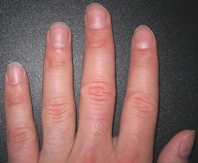 指甲有竖棱的原因以及体现出了什么