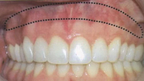 牙龈坏了的治疗方法以及应该如何修复牙龈