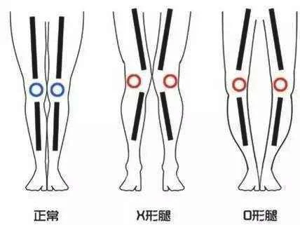 大腿腿型不直有哪些方法可以改善