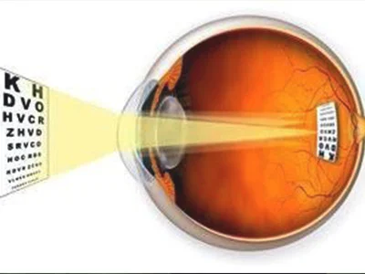 高度散光患者可以做手术纠正视力吗
