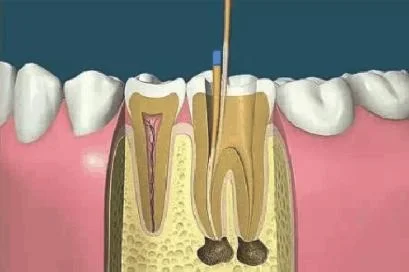 杀牙神经对于身体的好处与坏处有哪些