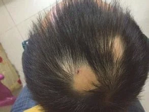 斑秃在治疗恢复期的头发生长规律