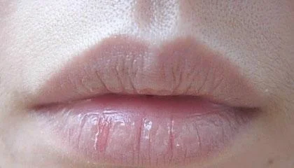 嘴唇经常起皮常见因素可能与以下三种情况有关