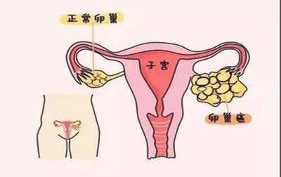 女人一旦有这三个特征就是卵巢癌候选人