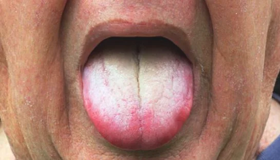 中医治疗舌苔很白一般有哪些常见疾病