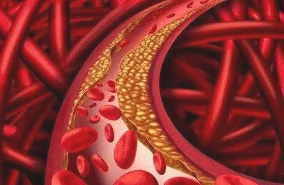 血管堵塞会导致很多疾病的出现如何清理血管呢
