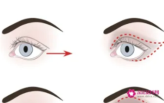 眼部凹陷是怎么形成的