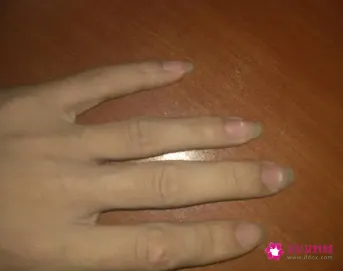 手指头有白点