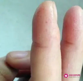 一只手指头痒是什么原因