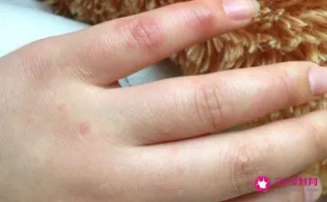 手指痒是什么病的前兆
