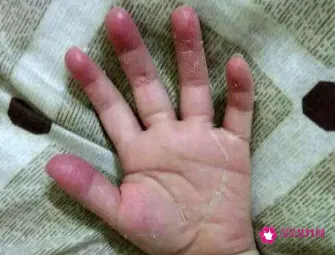 儿童手指脱皮是怎么回事