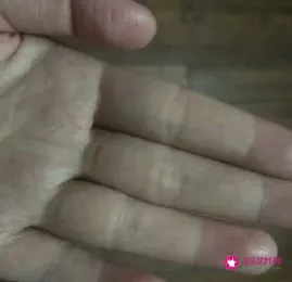 手指头痒是什么原因