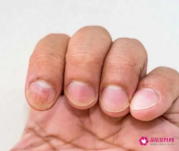 手指甲盖有白斑什么原因