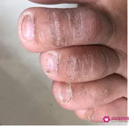 脚趾头和手指头痒是什么原因