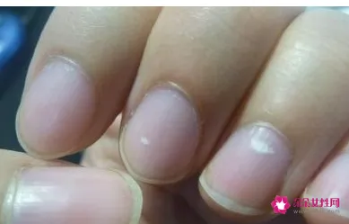 手指头有白点是什么
