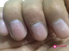 手指指甲出现白点是怎么了