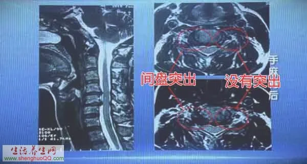 健康之路:手麻背后,颈椎病20160224陈赞,鲁梅花