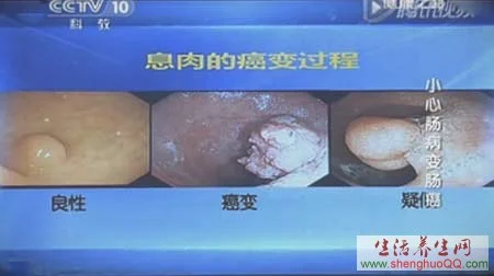 息肉的癌变过程www.yangshengpu.com