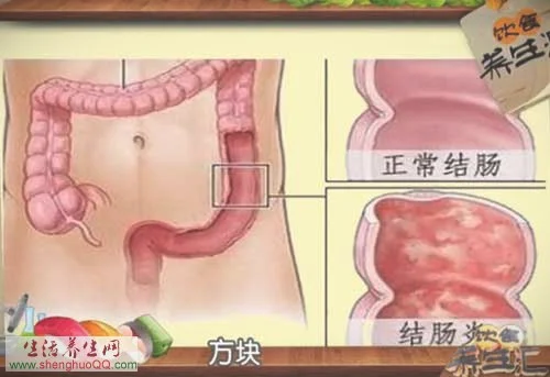 饮食养生汇:结肠炎的危害20150826梁学亚