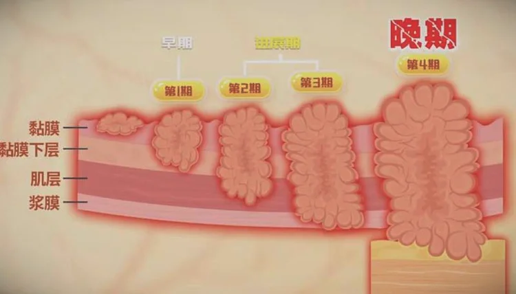 胃癌的四个时期-胃癌的四个阶段_图片
