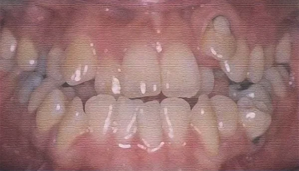 健康之路20171215牙齿不齐也是病