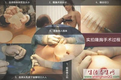 隆胸手术过程-图片