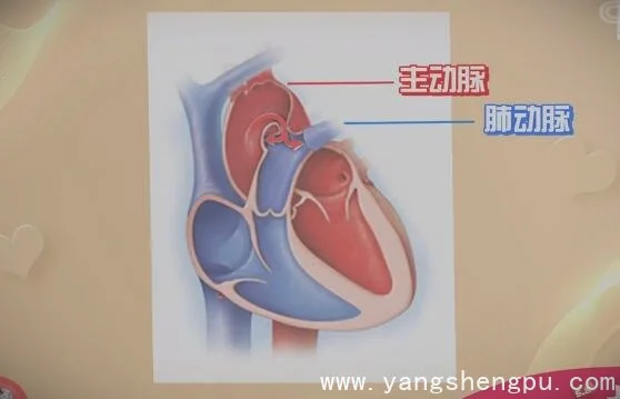 动脉导管未闭状态-心脏主动脉与肺动脉_图片