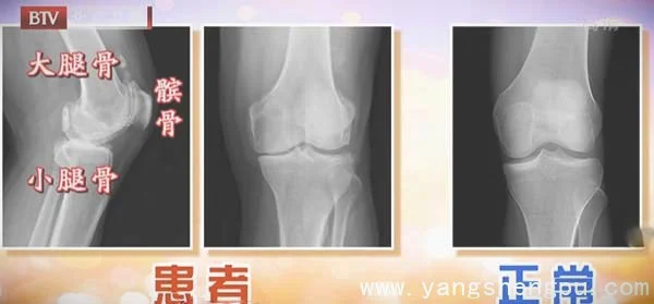 膝关节-关节软骨与半月板_图片