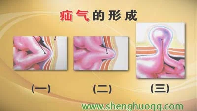 腹股沟疝气症状及形成过程