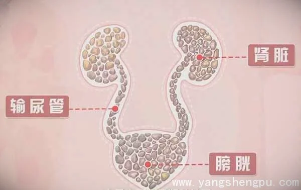 泌尿系统结石-最主要的是肾结石_图片