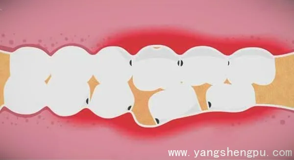 拔牙后牙齿丢失有什么影响