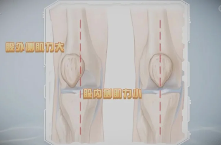 股外侧肌力线-膝关节肌肉失衡_图片
