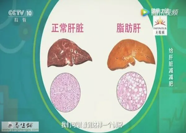  正常肝与脂肪肝的区别