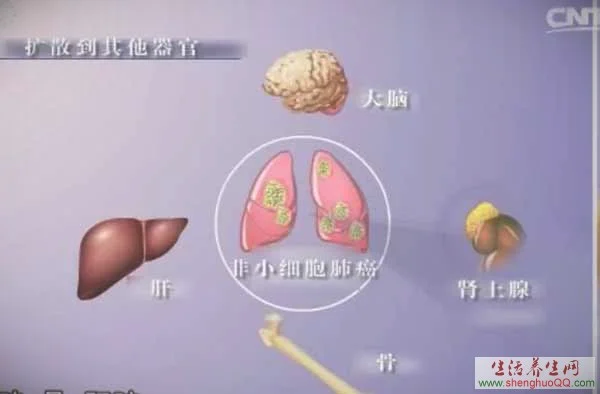 肺癌常见的转移部位