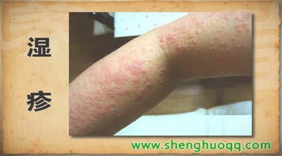 湿疹的特点及用芦荟治疗方法
