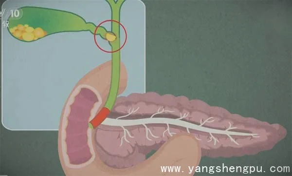 胆结石卡在胆囊出口_图片