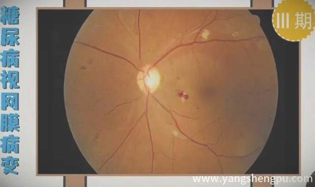健康之路 视网膜血管病变-糖尿病和高血压对眼睛