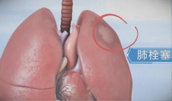 肺栓塞图片