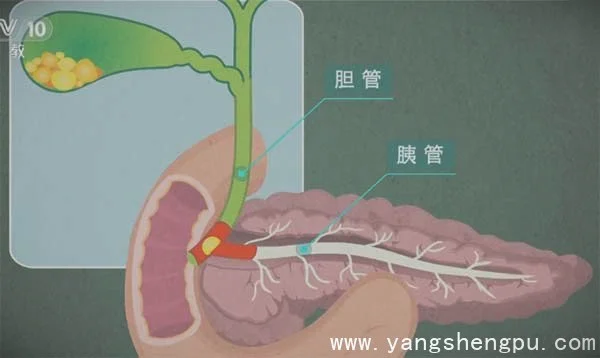 胆结石堵塞在胆管与胰管的交界处_图片
