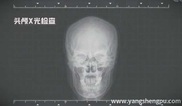 头颅X光检查-头颅x光片_图片