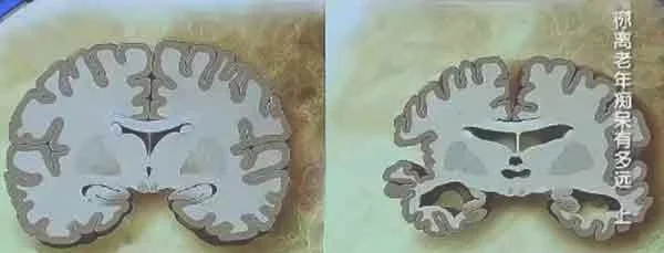 阿尔茨海默症的脑组织